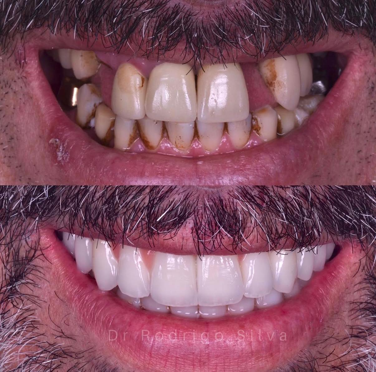 Paciente sorrindo após colocar implante dentário em Curitiba no consultório odontológico do Dr Rodrigo Silva